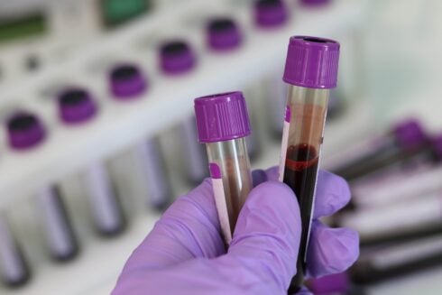 hundreds-of-costa-del-sol-patients-wrongly-told-they-may-have-colon-cancer-after-malaga-hospital-lab-sends-false-positives