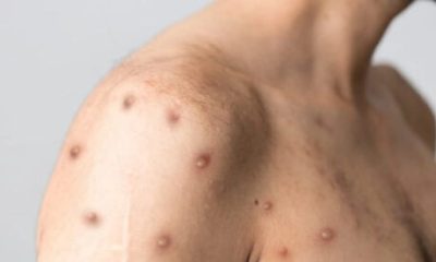 monkeypox-case-confirmed-at-marbella-hospital-as-patient-is-admitted-–-health-authorities-urge-calm