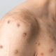 monkeypox-case-confirmed-at-marbella-hospital-as-patient-is-admitted-–-health-authorities-urge-calm