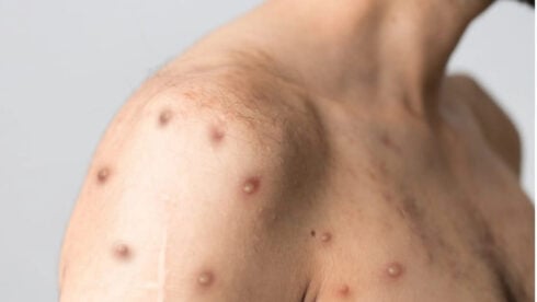 An adult male torso with monkeypox
