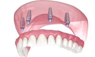 inside-the-advanced-implants-and-cosmetic-wonders-of-torremolinos’-highly-experienced-british-dentist