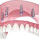 inside-the-advanced-implants-and-cosmetic-wonders-of-torremolinos’-highly-experienced-british-dentist