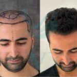 best-hair-transplant-surgeons-turkey-2026